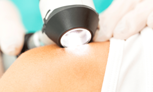 Augmentation des cancers de la peau : comment améliorer la prévention ?